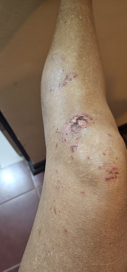 Cuts and grazes down a leg, dried blood, war wounds from a race
